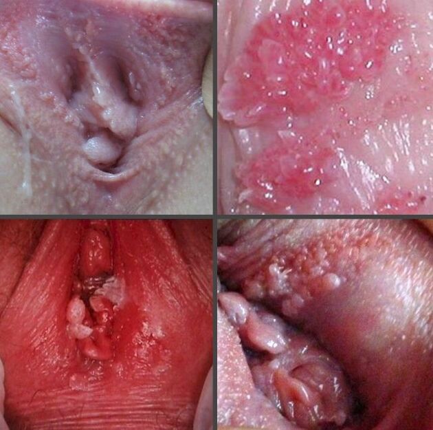 Primer plano de papilomas en la vagina