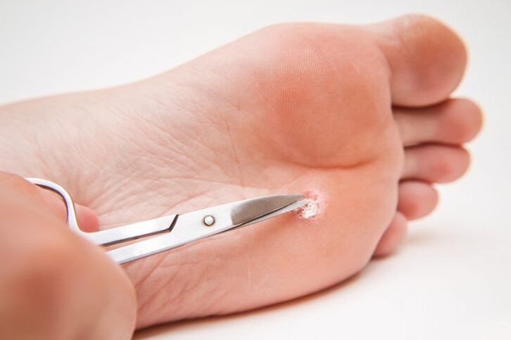 cortando una verruga en la pierna