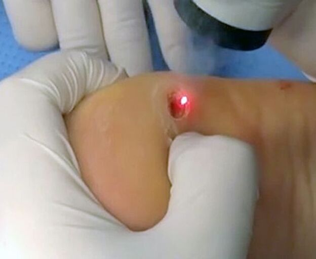 El procedimiento para eliminar las verrugas en el talón mediante láser. 